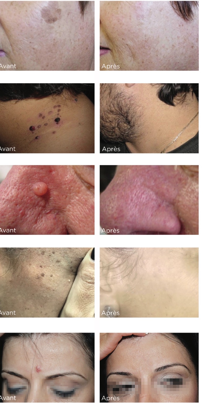 Cryothérapie médicale pour lésions cutanées